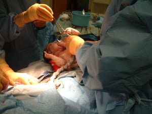 personal injury lawsuit C-section